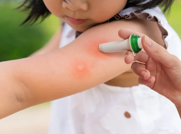 mosquito bites treatment